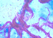 Kinyoun smear from liquid culture growth. This is an example of cording where AFB clump together in a distinct pattern, often seen in Mycobacterium tuberculosis 